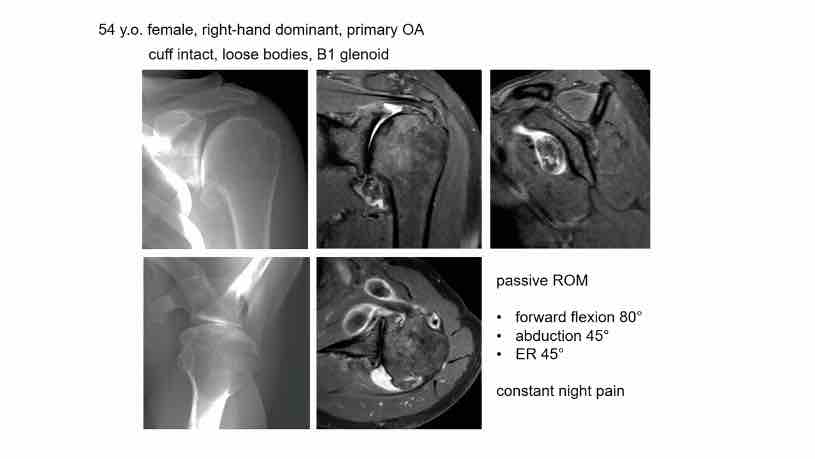 Session 1: Difficult Indications in Shoulder Arthroplasty – thumbnail 2 of 8