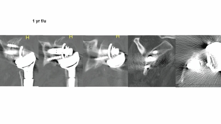 Challenges and Possible Solutions in Shoulder Arthroplasty – thumbnail 2 of 8