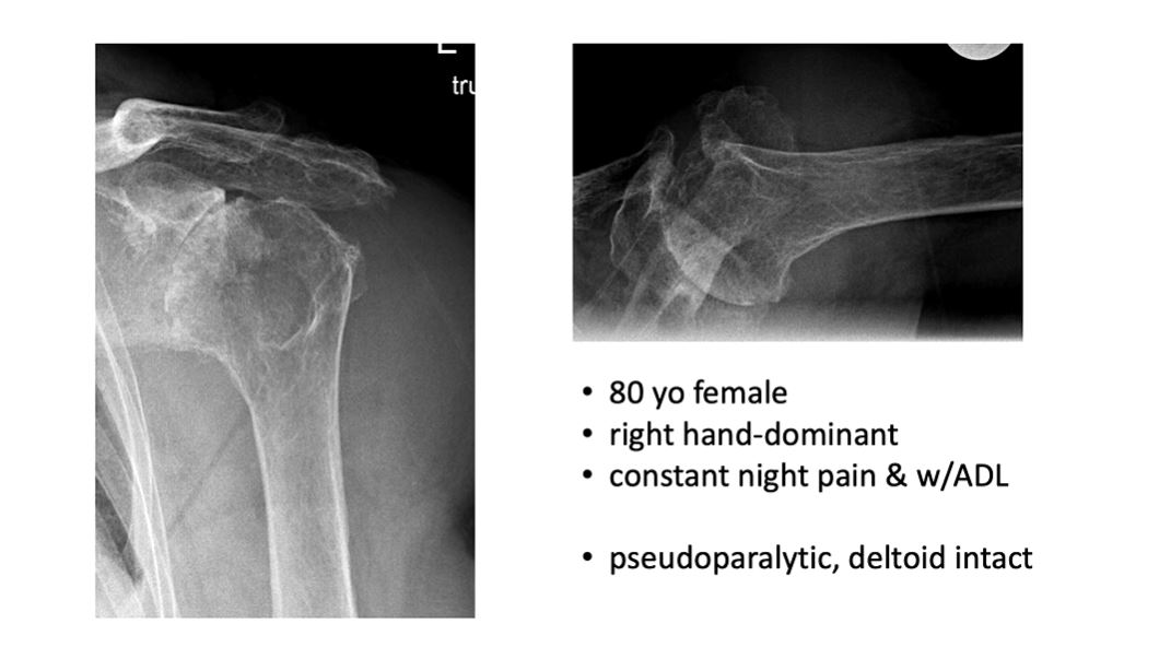 Technology in Shoulder Arthroplasty: Current Developments – thumbnail 2 of 9