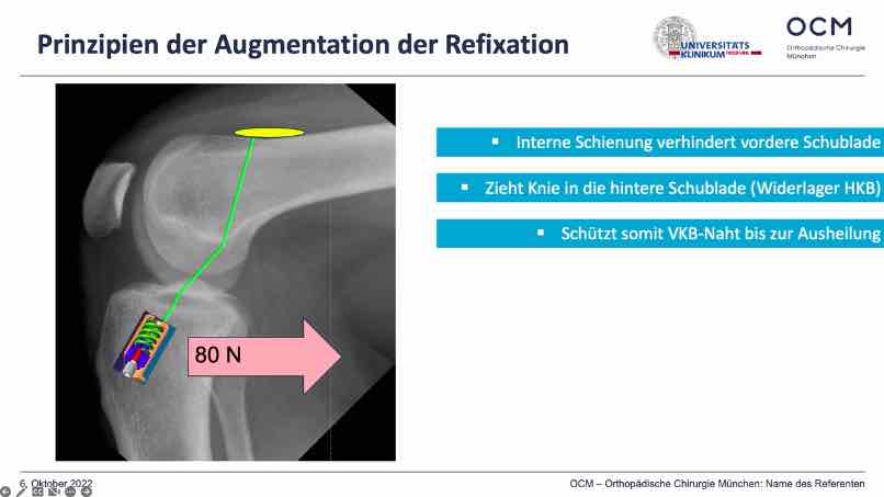 #610: VKB-Erhalt nach Ruptur – thumbnail 2 of 11