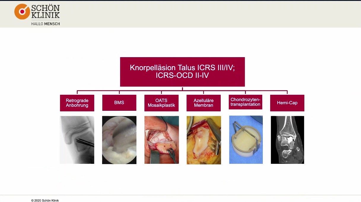 #187: Knorpelschaden am Talus - was nun? – thumbnail 2 of 7