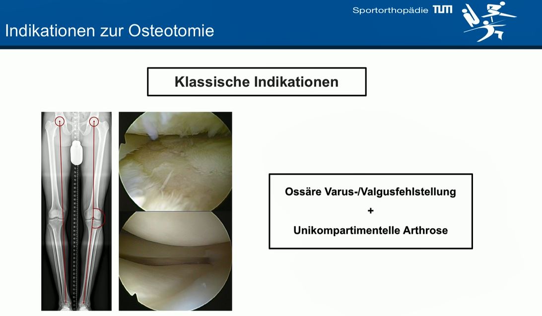 #196: Insights from the OR - Kniegelenknahe Osteotomien – thumbnail 2 of 9