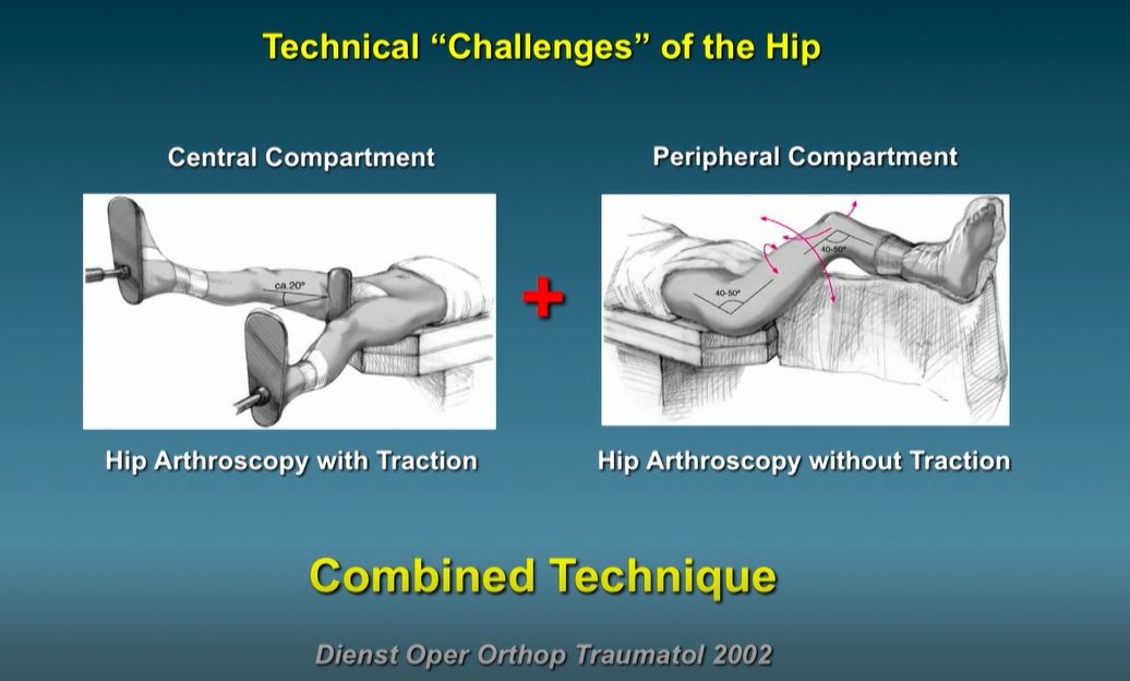 #192: Hip International - Basic Principles of Hip Arthroscopy – thumbnail 2 of 13