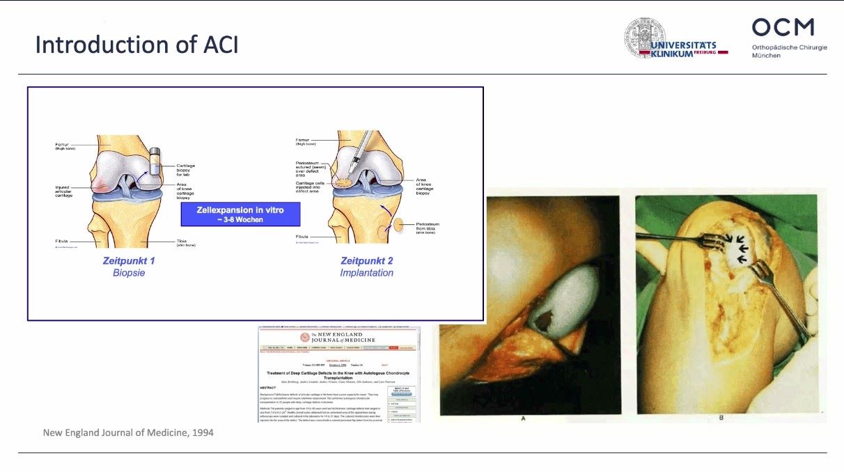 ICRS TV Series - #008: Chondrocyte and Fragmented Cartilage: Products and Procedures – thumbnail 2 of 12