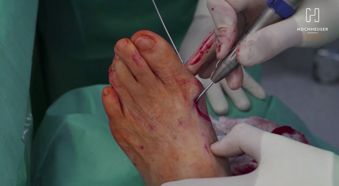 Winglet Originals #013: Minimally Invasive Foot Surgery – thumbnail 2 of 13