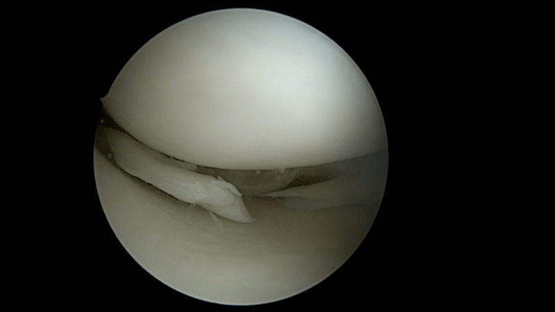 #254: Insights from the OR - Meniskuschirurgie – thumbnail 2 of 12