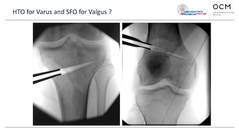 Winglet Originals #002: Indications for Osteotomies Around the Knee – thumbnail 2 of 12
