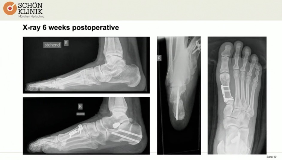 #1711: Insights from the OR - Hindfoot Surgery – thumbnail 2 of 7