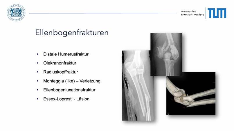 AGAnywhere Monthly - #016: Frakturen des Ellenbogens - Spannungsfeld zwischen Rekonstruktion und Ersatz – thumbnail 2 of 12