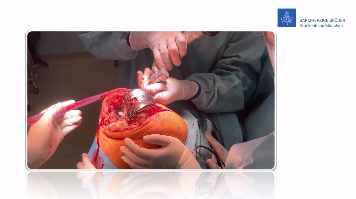 Winglet Originals #015: Revision Knee Arthroplasty – thumbnail 2 of 18