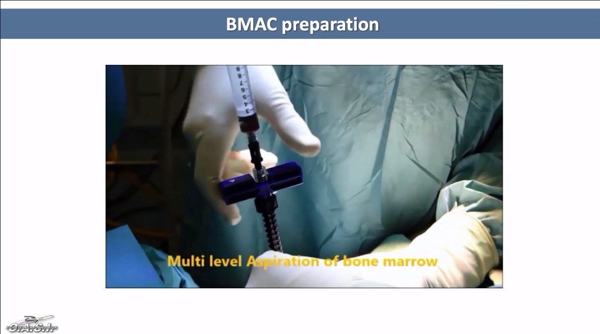 ICRS TV Series - #005: Biologic Knee Replacement: Basic Science of Aging of Cartilage – thumbnail 3 of 12