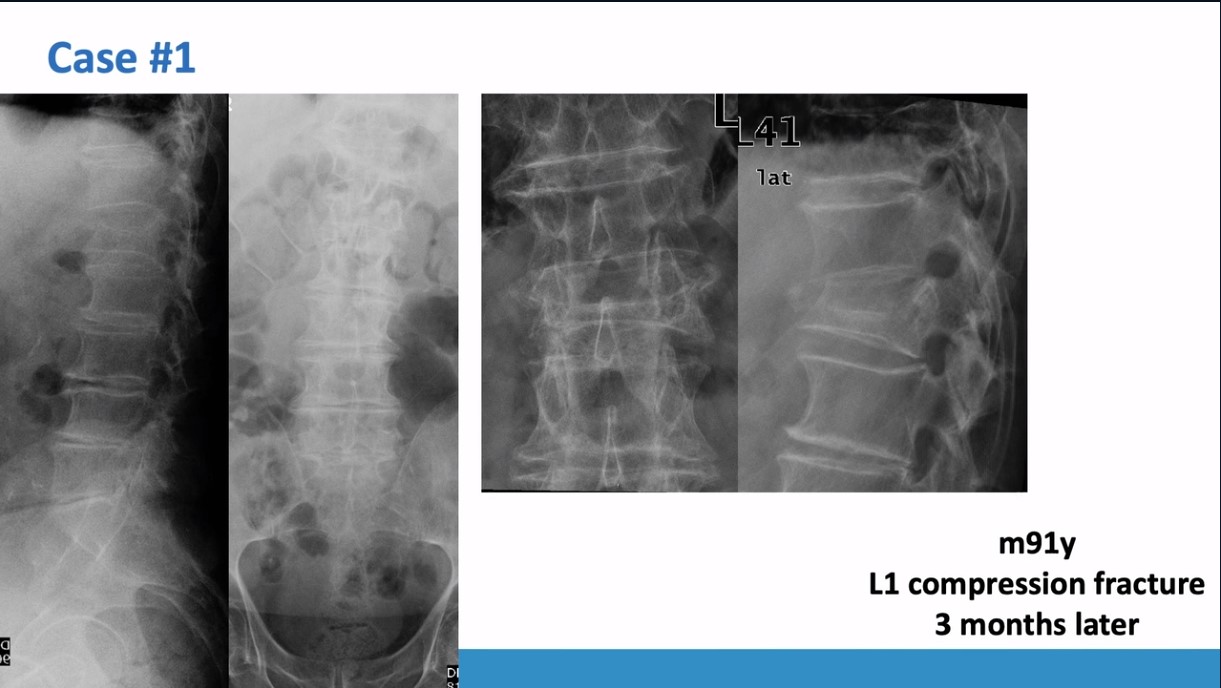Winglet Originals #020: Minimally-Invasive Fixation of Thoracolumbar Osteoporotic Vertebral Compression Fractures – thumbnail 3 of 13