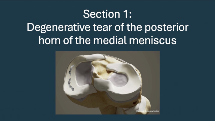 ICRS TV Series - #010: Meniscus Lesions: To Operate or Not To Operate? – thumbnail 3 of 10