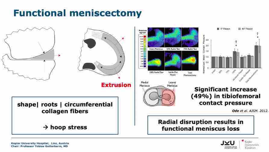 Winglet Originals #007: Complex Meniscal Pathologies – thumbnail 3 of 13