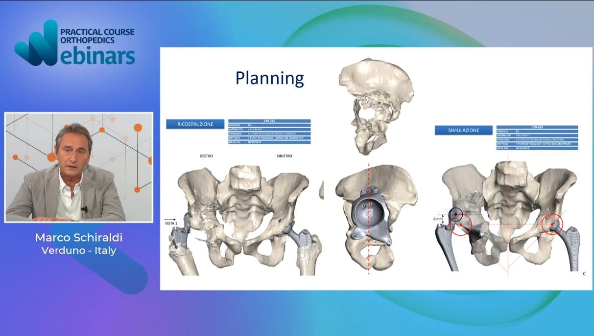 #295: Custom Implants for Acetabular Reconstruction – thumbnail 3 of 6