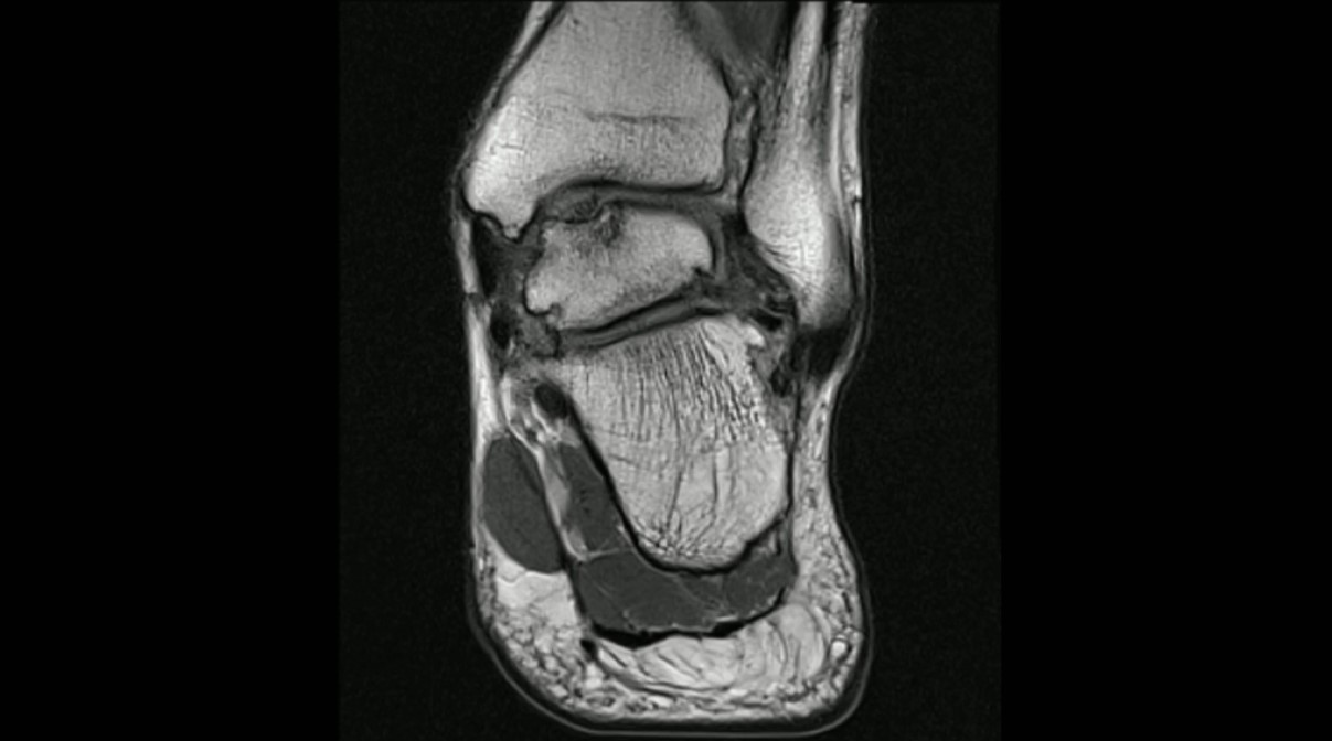 #187: Knorpelschaden am Talus - was nun? – thumbnail 3 of 7