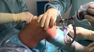 Orthopedic Film Festival 2023 – Lower Extremity & Sports – thumbnail 3 of 17