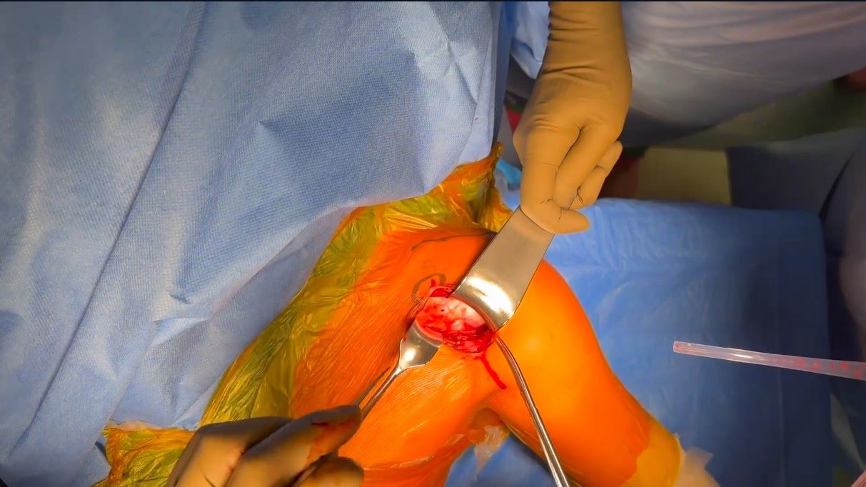 Orthopedic Film Festival 2024 – Upper Extremity & Sports – thumbnail 3 of 16