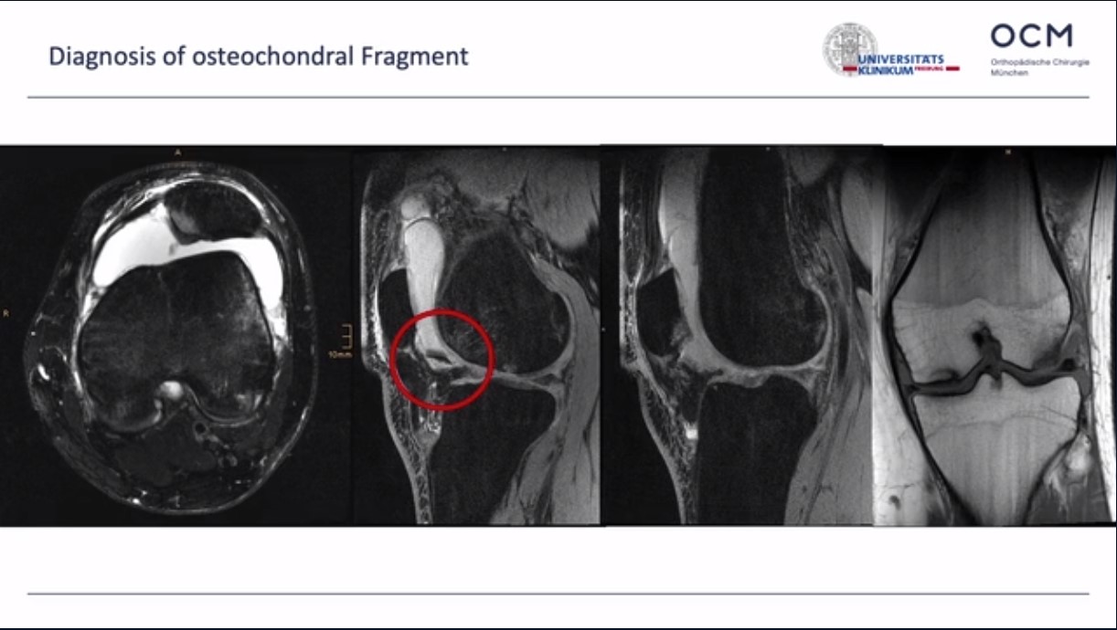 Across the Atlantic: American and European Insights on Patellar Instability – thumbnail 3 of 14
