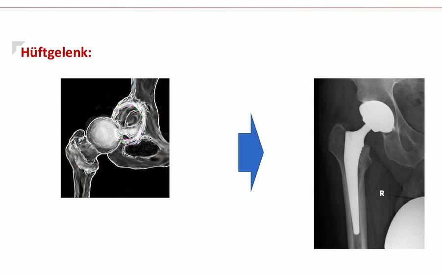 #611: Für die Praxis - Sport mit Endoprothese – thumbnail 3 of 9