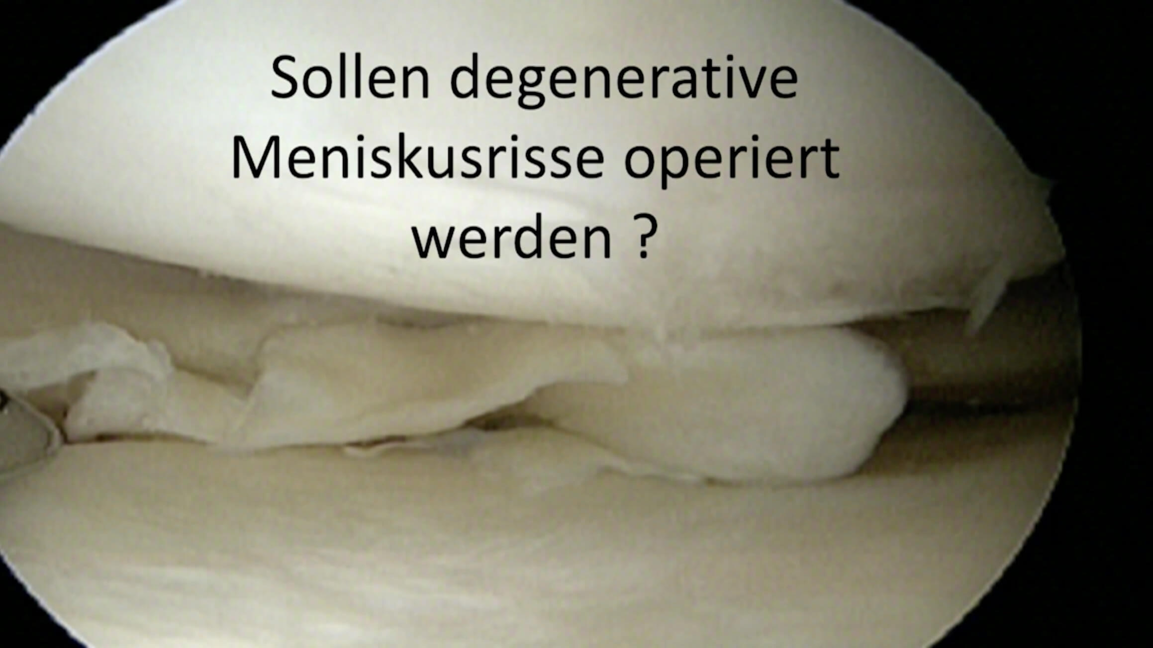 #254: Insights from the OR - Meniskuschirurgie – thumbnail 3 of 12