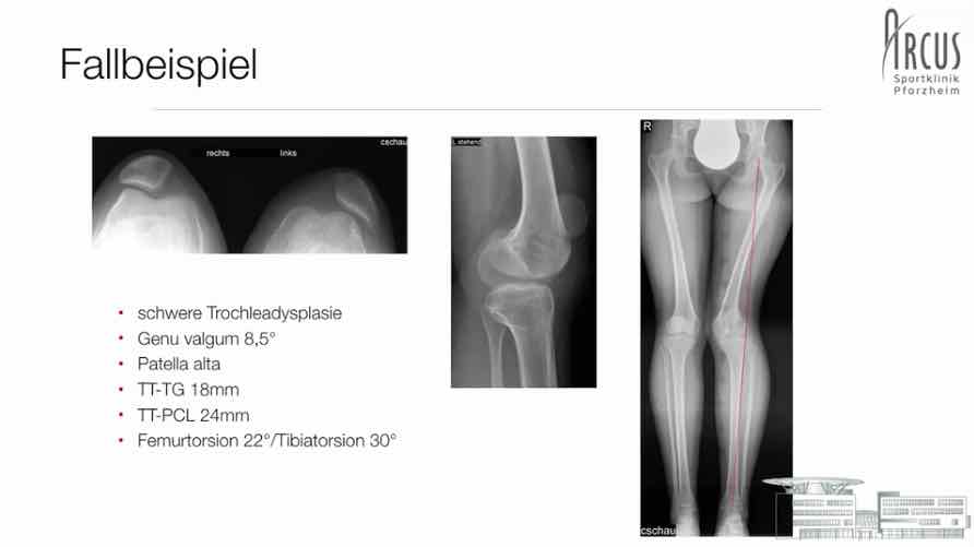 Spezifischer Knieschmerz - Session 1: Instabilitäten – thumbnail 3 of 10