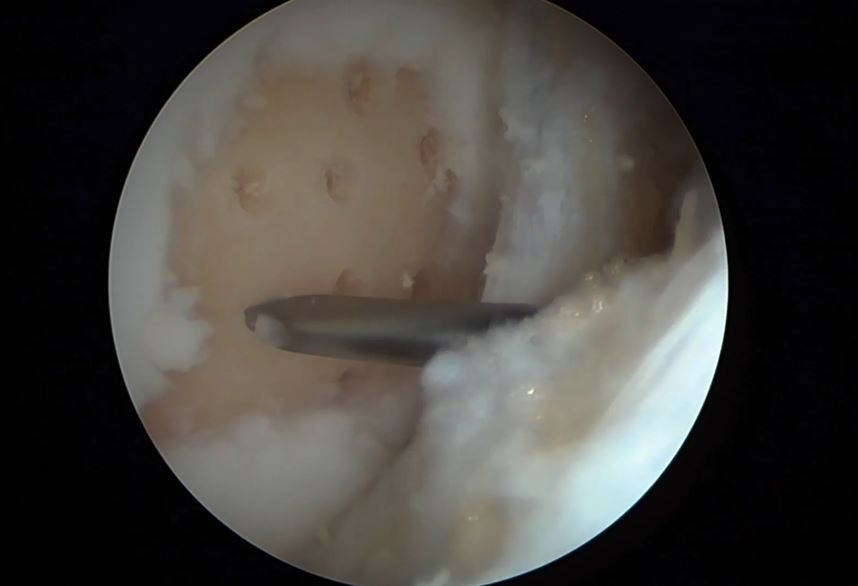 #181: Insights from the OR - Knorpelchirurgie III – thumbnail 3 of 11