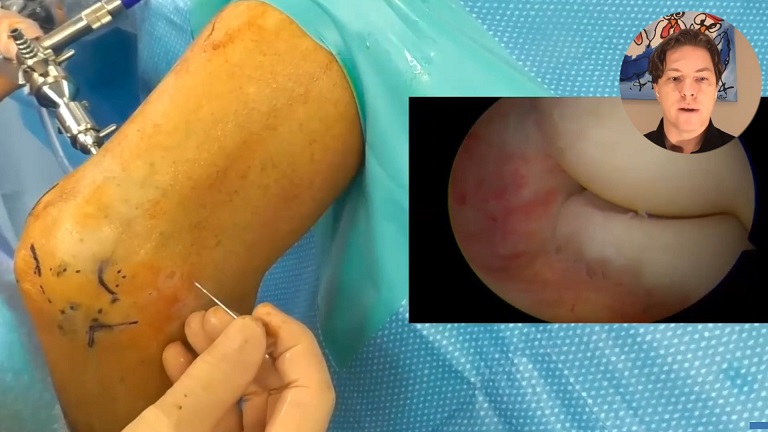 #1212: Insights from the OR - Capsular Release of the Elbow – thumbnail 3 of 8