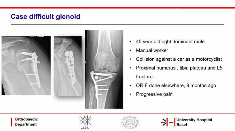 Session 1: Difficult Indications in Shoulder Arthroplasty – thumbnail 3 of 8