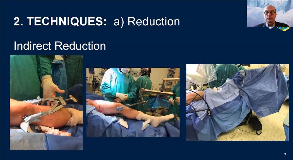 Winglet Originals #018: Minimally Invasive Pelvis & Acetabular Fracture Fixation – thumbnail 3 of 12