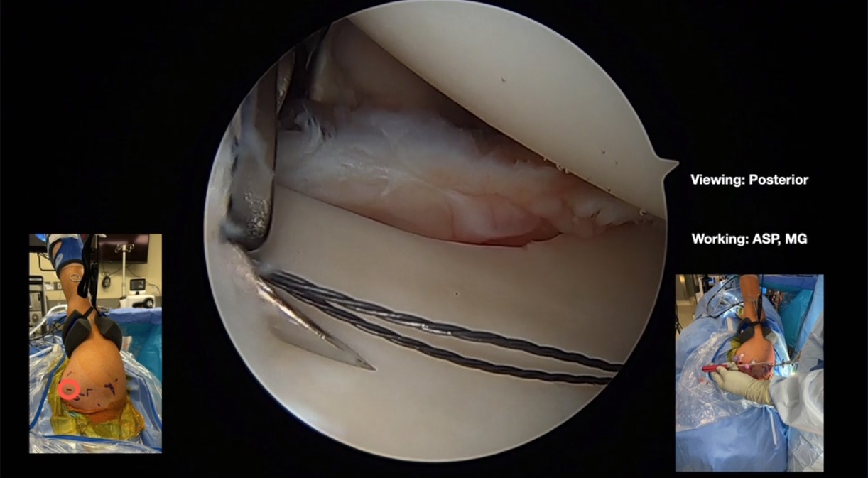 Across the Atlantic: American and European Insights on All Things Biceps Tendon – thumbnail 3 of 16
