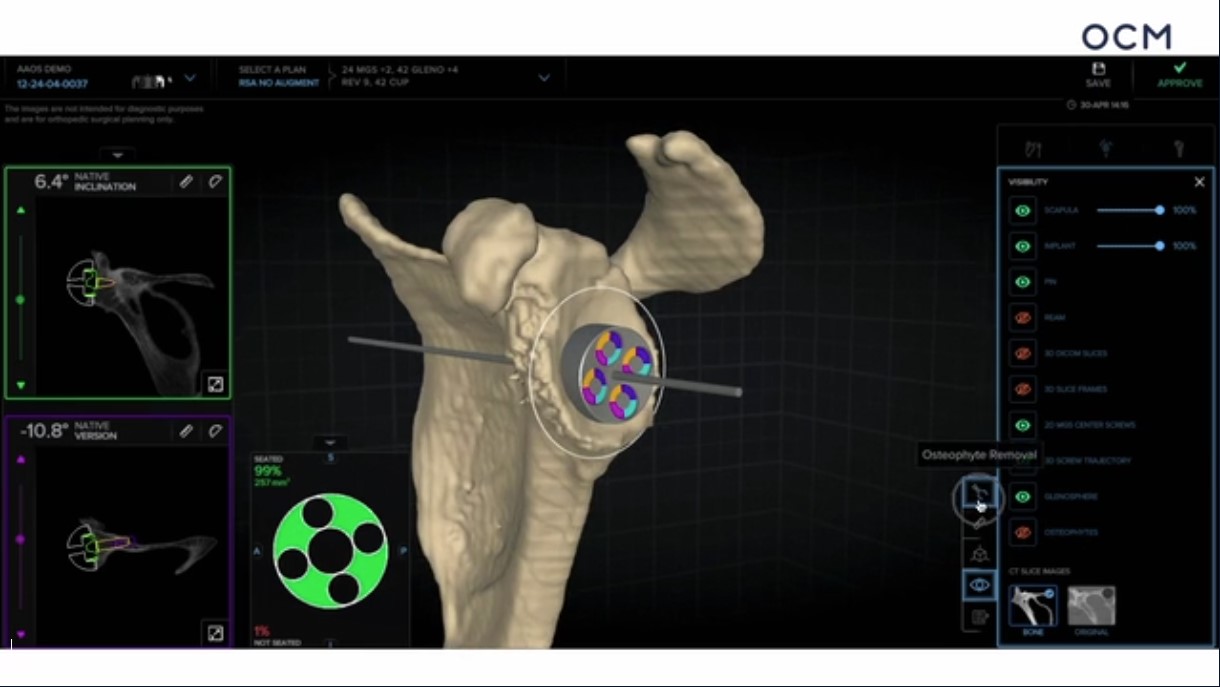 Winglet Originals #023: Planning & Augmented Reality in Shoulder Surgery – thumbnail 3 of 11