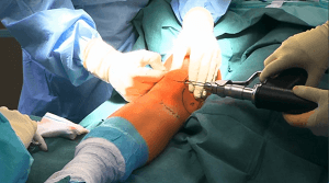 #1010: Insights from the OR - Patellainstabilität – thumbnail 3 of 9