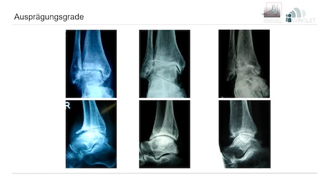 #223: Sprunggelenksarthrose - Therapiemöglichkeiten und Grenzbereiche – thumbnail 4 of 10