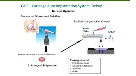 AGAnywhere Monthly - #010: Behandlung von chondralen und osteochondralen Defekten am Kniegelenk – thumbnail 4 of 12