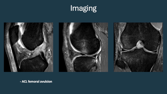 ICRS TV Series - #010: Meniscus Lesions: To Operate or Not To Operate? – thumbnail 4 of 10