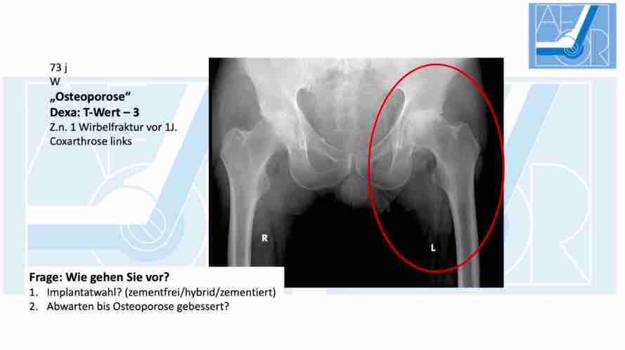 Update Hüftschaftversorgung - Folge 2: Patientenspezifische Faktoren – thumbnail 4 of 9
