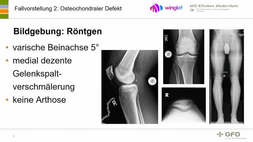 #115: ACT 4.0 Regenerative Knorpeltherapie - so geht's! – thumbnail 4 of 10