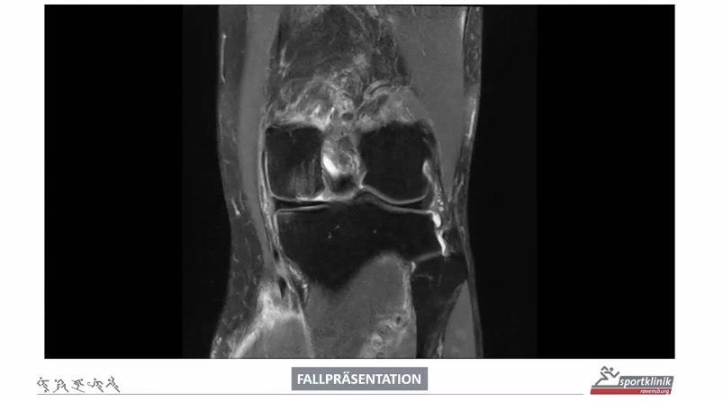 FKT@Home 2022 (Tag 1) - Knorpelregeneration am Kniegelenk – thumbnail 4 of 10