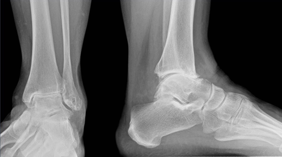 AGAnywhere Monthly - #007: Arthrose am Sprunggelenk – thumbnail 4 of 13