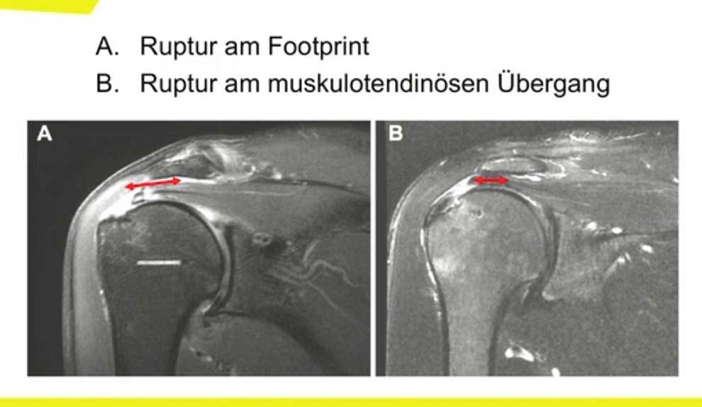 #2611: Update Rotatorenmanschette – thumbnail 4 of 12