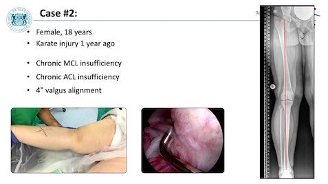 Winglet Originals #002: Indications for Osteotomies Around the Knee – thumbnail 4 of 12