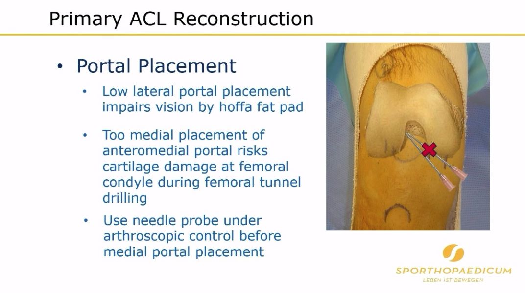 Winglet Originals #012: ACL Reconstruction – thumbnail 4 of 13