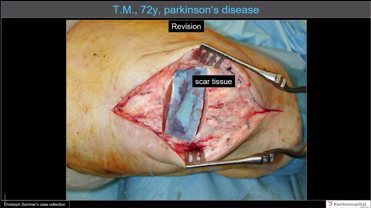 Winglet Originals #016: Patella Fractures – thumbnail 4 of 12