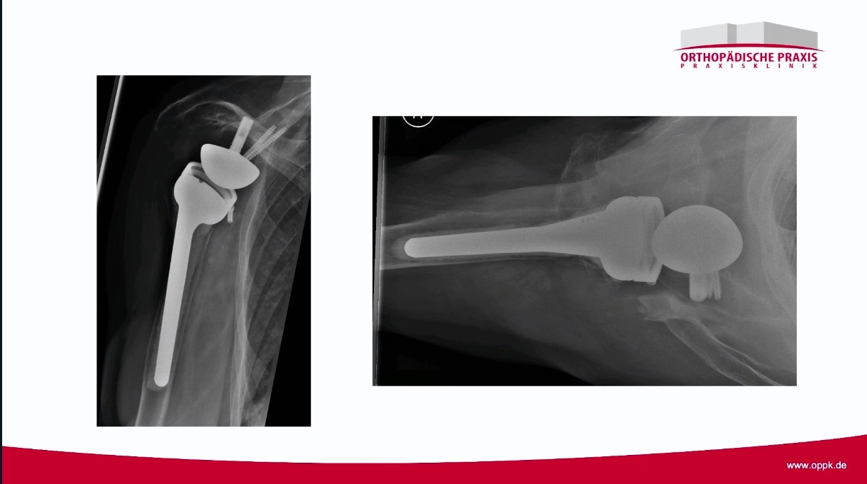 Winglet Originals #021: Reverse Shoulder Arthroplasty – thumbnail 4 of 11