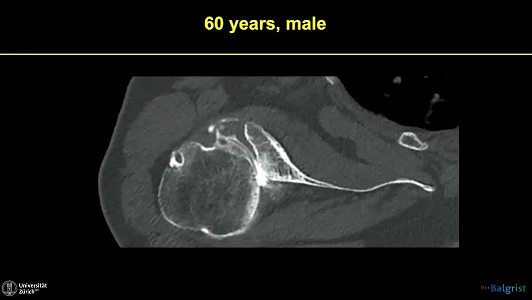 Technology in Shoulder Arthroplasty: Current Developments – thumbnail 4 of 9
