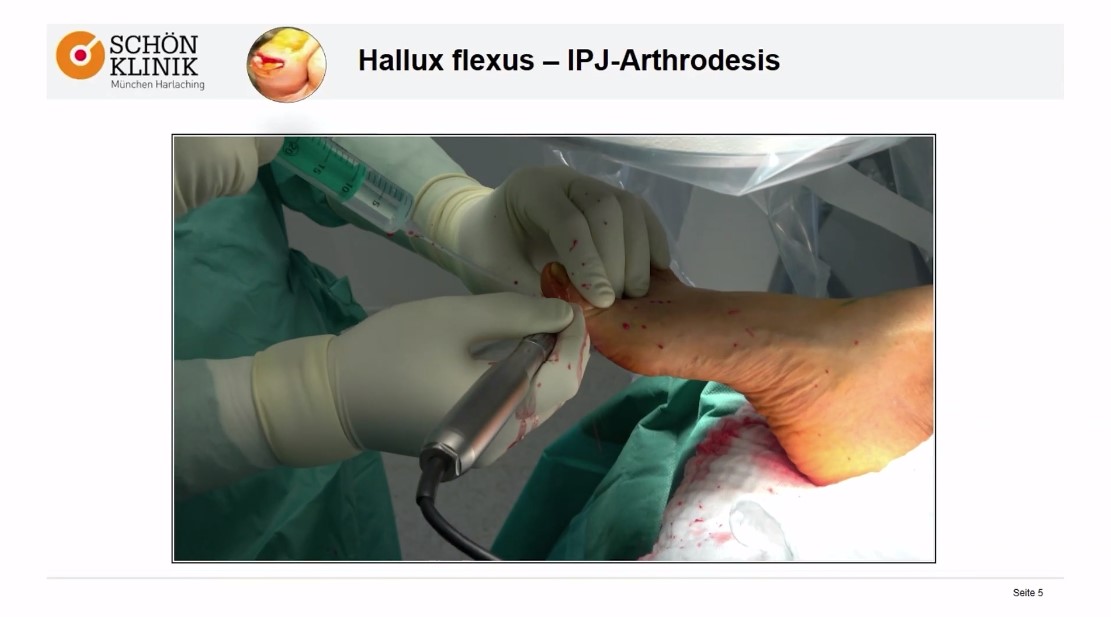 Winglet Originals #013: Minimally Invasive Foot Surgery – thumbnail 4 of 13