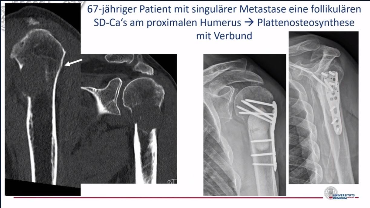 VSOU TV-Serie - Folge 2: Knochentumore – thumbnail 4 of 13