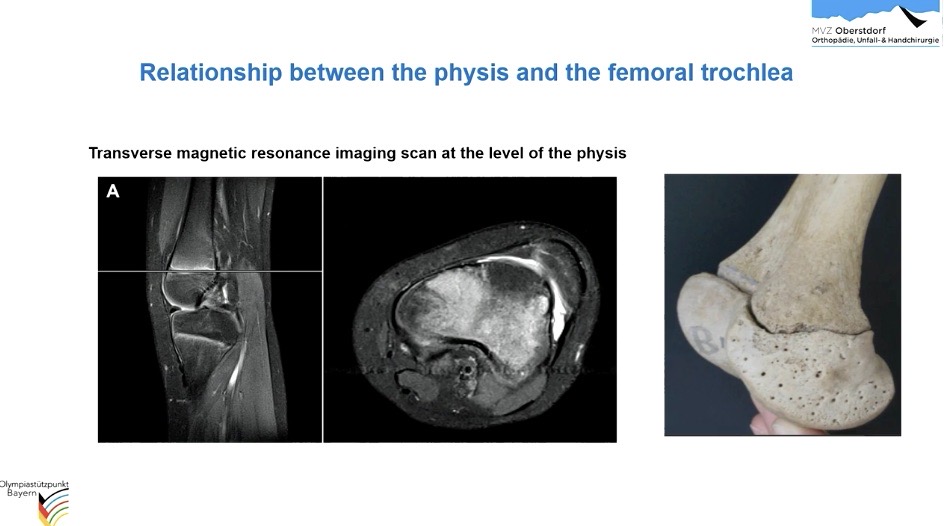 AGAnywhere Monthly - #008: Patellofemorale Instabilität – thumbnail 4 of 12