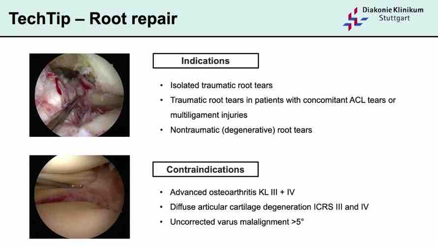 Winglet Originals #007: Complex Meniscal Pathologies – thumbnail 4 of 13